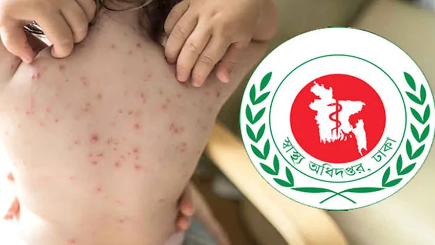 দেশে হাম ও উপসর্গে আরও ১১ শিশুর মৃত্যু, সংক্রমণ বাড়ছে বলে সতর্কতা
