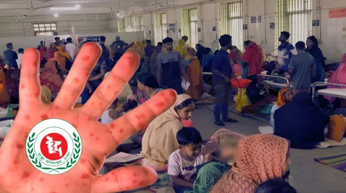 ২৪ ঘণ্টায় হাম ও হামের উপসর্গ নিয়ে ৮ শিশুর মৃত্যু