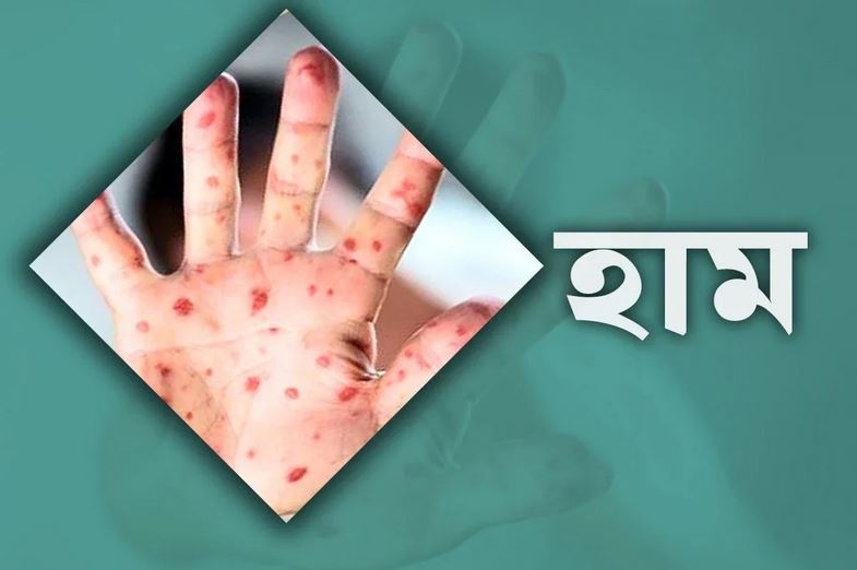 ২৪ ঘণ্টায় হাম ও উপসর্গে আরও ১১ শিশুর মৃত্যু
