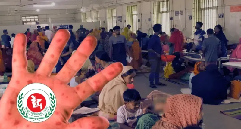হাম ও উপসর্গে আরও ৭ শিশুর মৃত্যু, মোট মৃত্যু ৩২৪